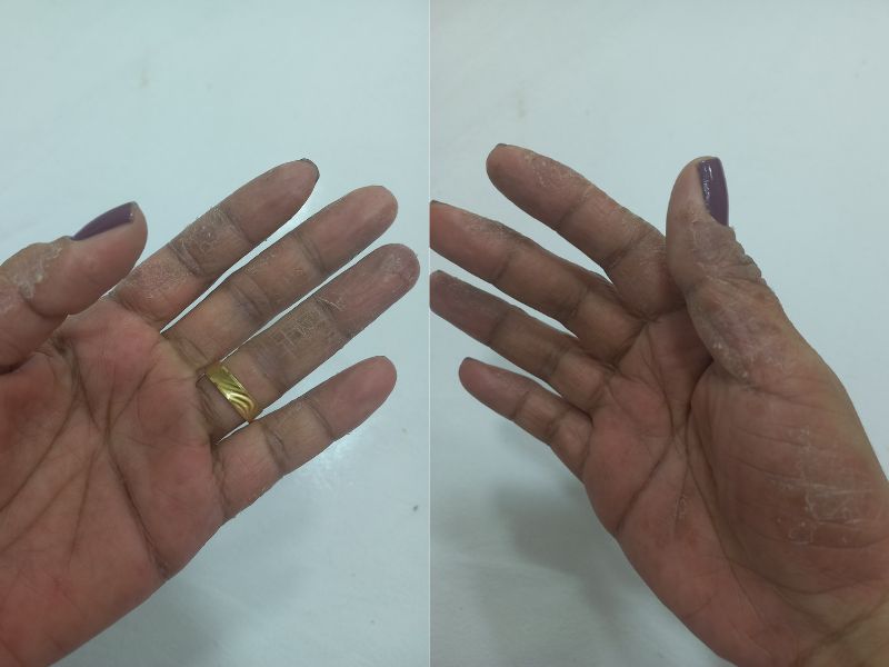 Durante uma das fases mais graves da doença, as fissuras e o ressecamento intenso transformaram tarefas simples em grandes desafios.