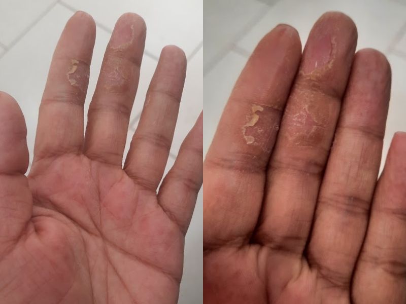 Mãos com dermatite de contato alérgica apresentando ressecamento intenso, fissuras e descamação causadas por alergia à Metilisotiazolinona (MIT).