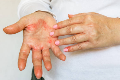 Mãos com dermatite de contato apresentando ressecamento intenso, descamação, fissuras e vermelhidão.