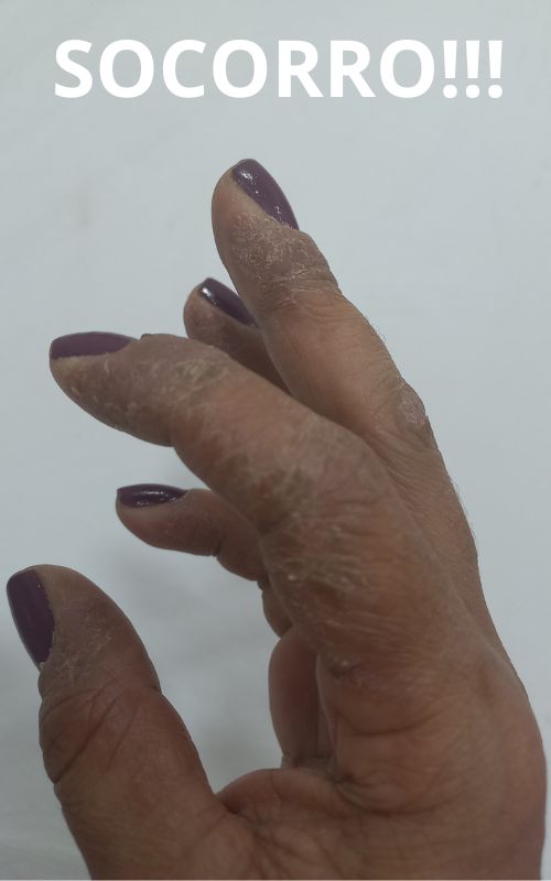 Minha mão durante uma crise de dermatite de contato alérgica, com descamação intensa e ressecamento, ilustrando sintomas que podem ser confundidos com pele sensível.